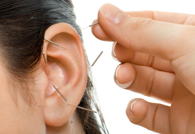Nahaufnahme eines Ohrs mit mehreren Akupunkturnadeln, die für Aurikulotherapie und Reflexzonentherapie zur Gesundheitsförderung eingesetzt werden